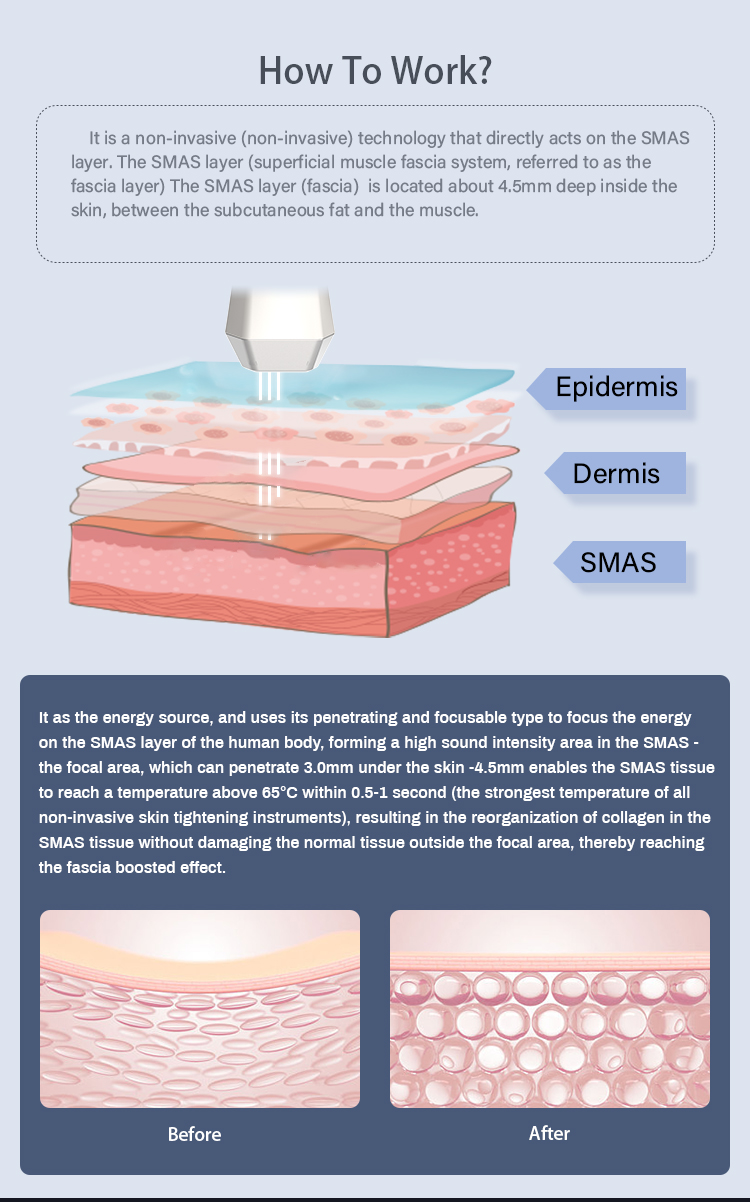 HIFU Treatments - White Edition